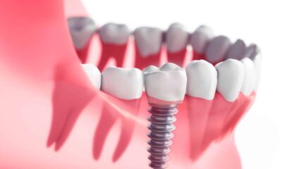 Rediscover Your Smile: Implant Dentists and Dental Implants in Las Vegas