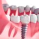 Rediscover Your Smile: Implant Dentists and Dental Implants in Las Vegas