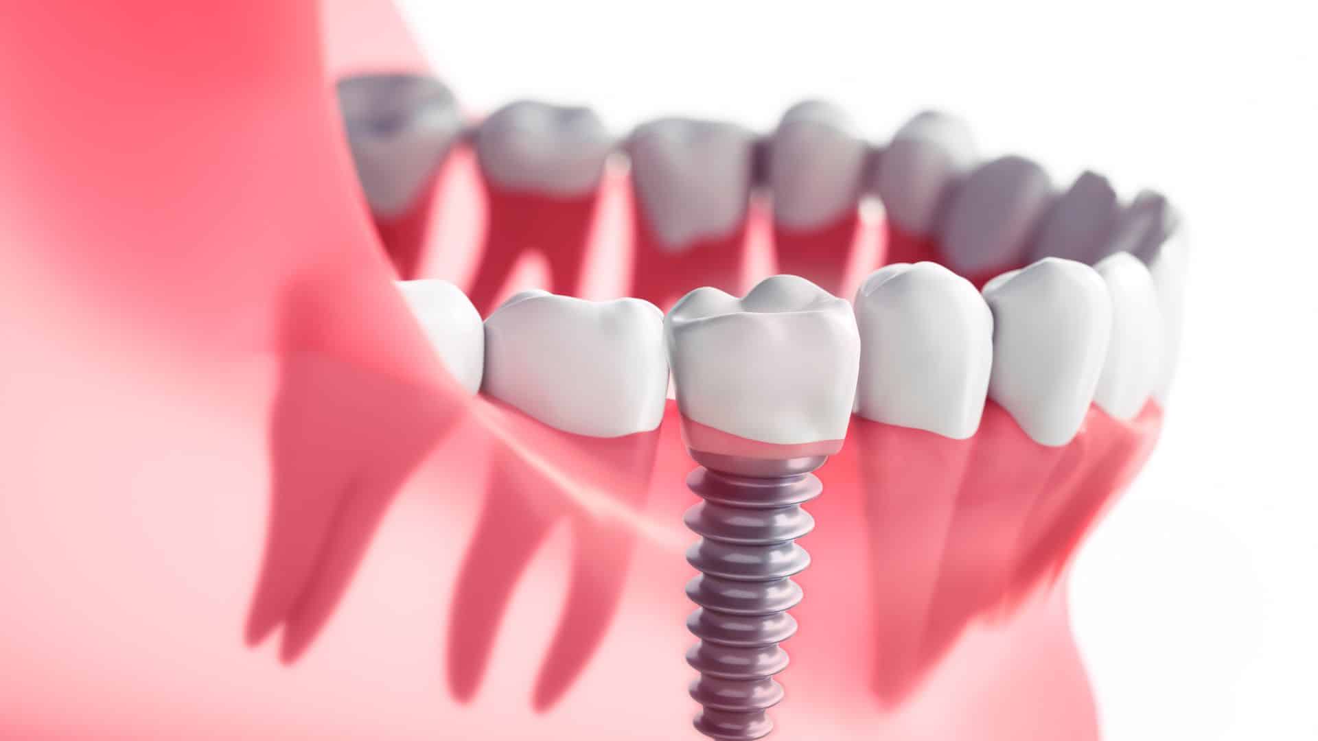 Rediscover Your Smile: Implant Dentists and Dental Implants in Las Vegas